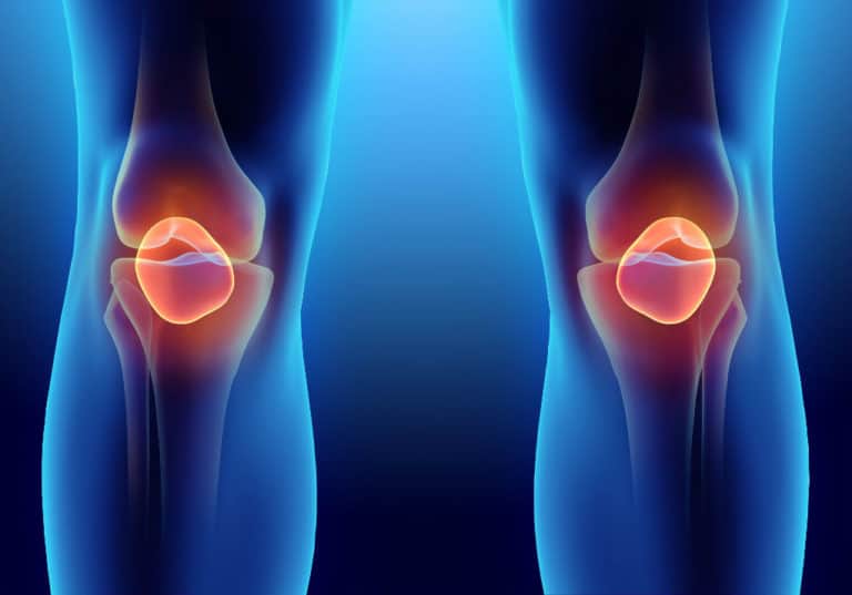 Knee Arthroscopy